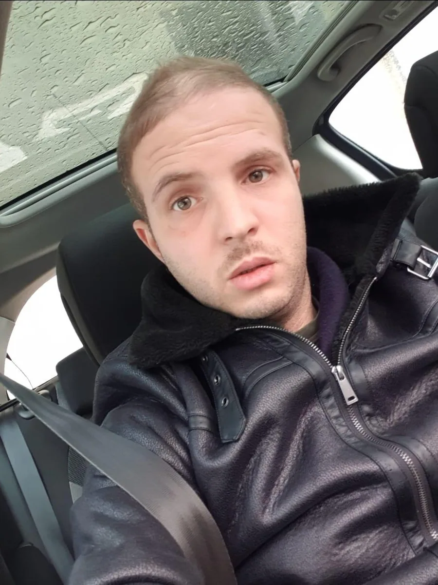 Before hair restoration