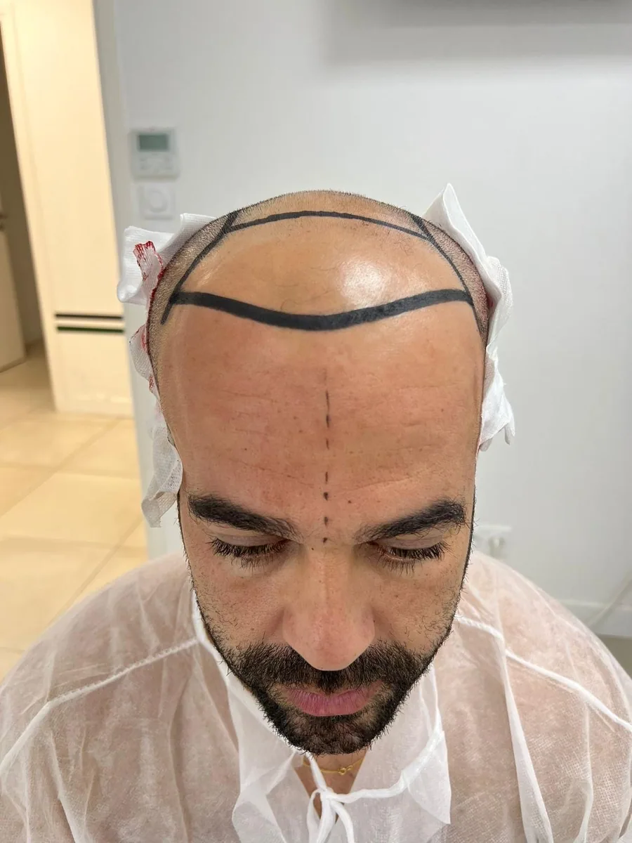 Before hair restoration