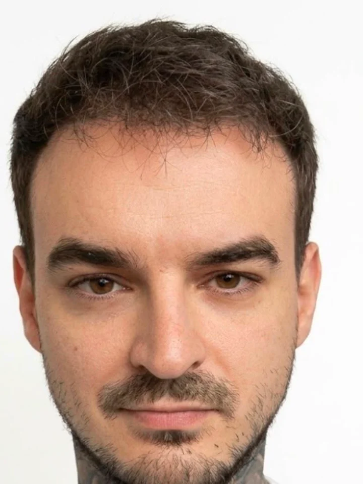 After hair restoration