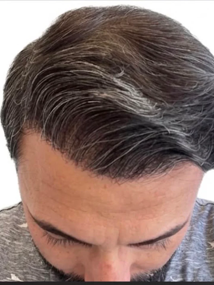 After hair restoration